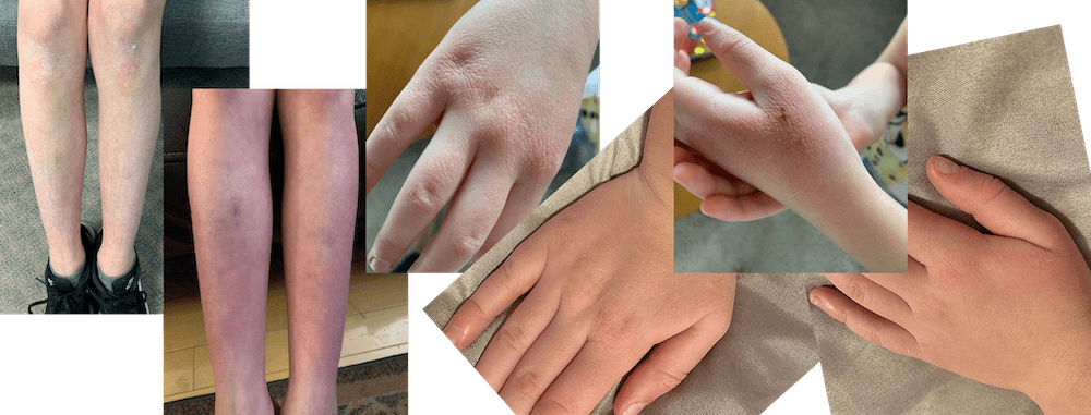 Let’s Talk About Eczema