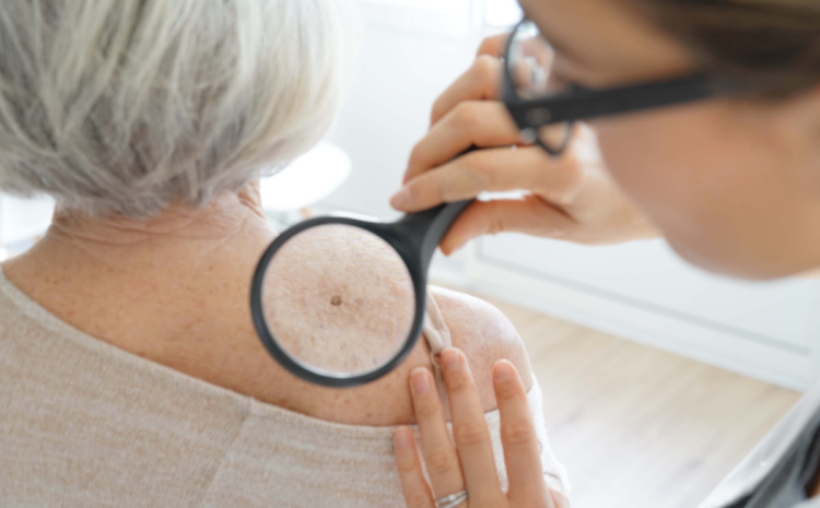  Skin Cancer Prevention: Heightening Awareness